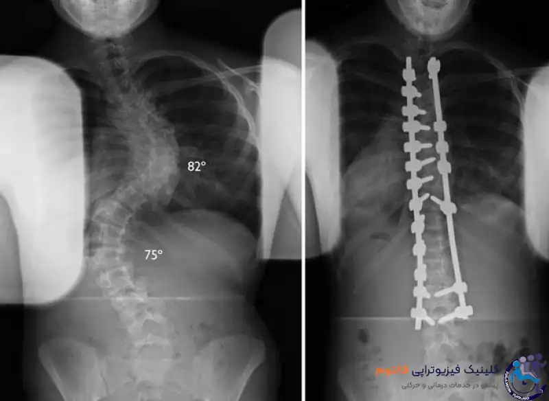 علائم اسكليوز