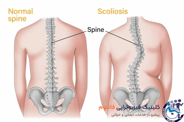 علائم اسكليوز