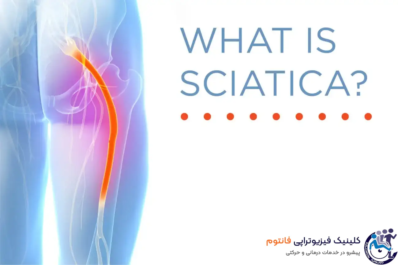 درد سیاتیک چیست؟