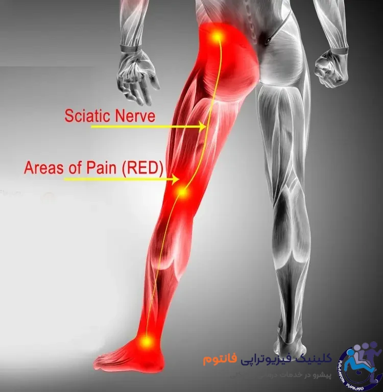 درد سیاتیک چیست؟