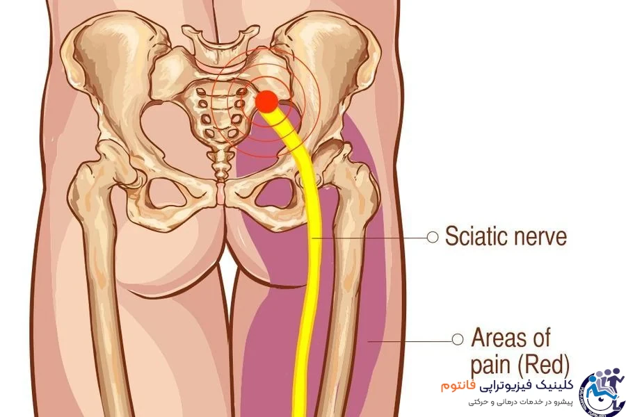 درد سیاتیک چیست؟