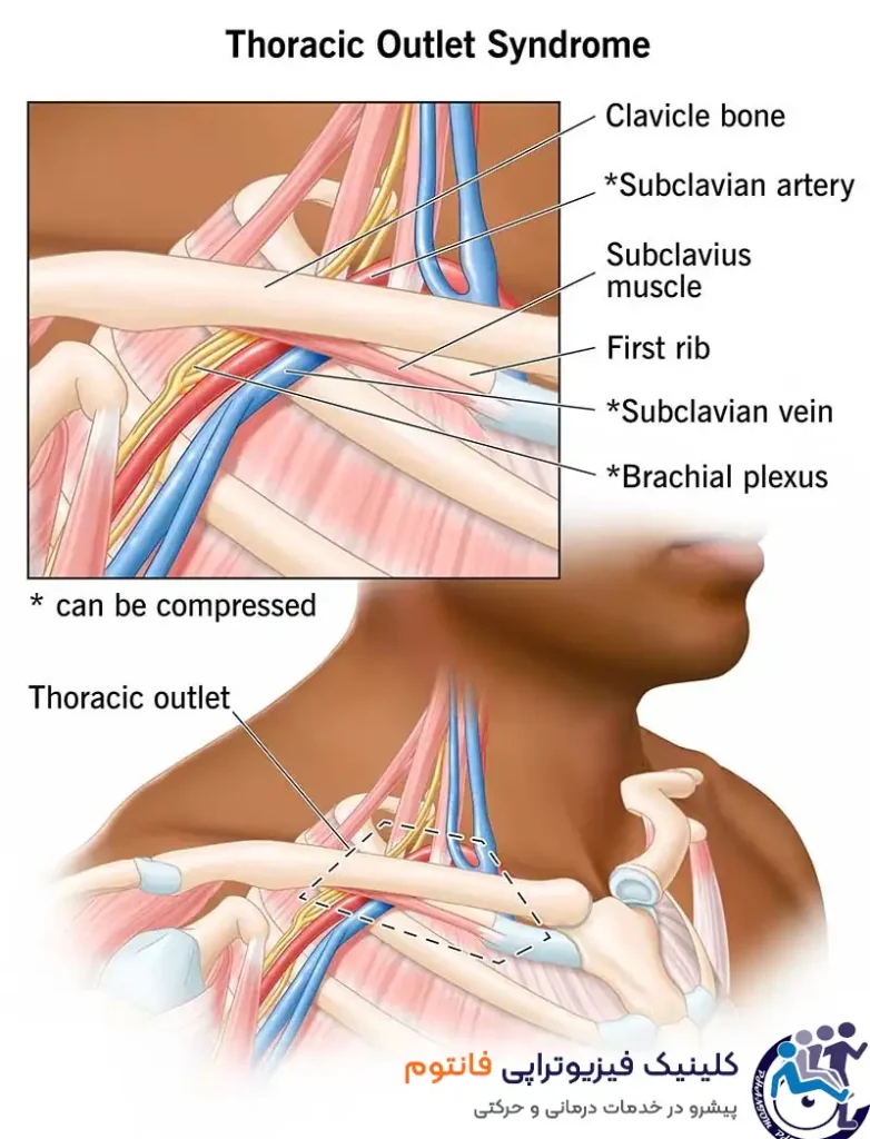  سندرم خروجی قفسه سینه 