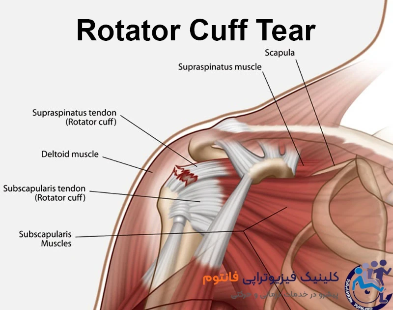 علائم پارگی تاندونهای شانه