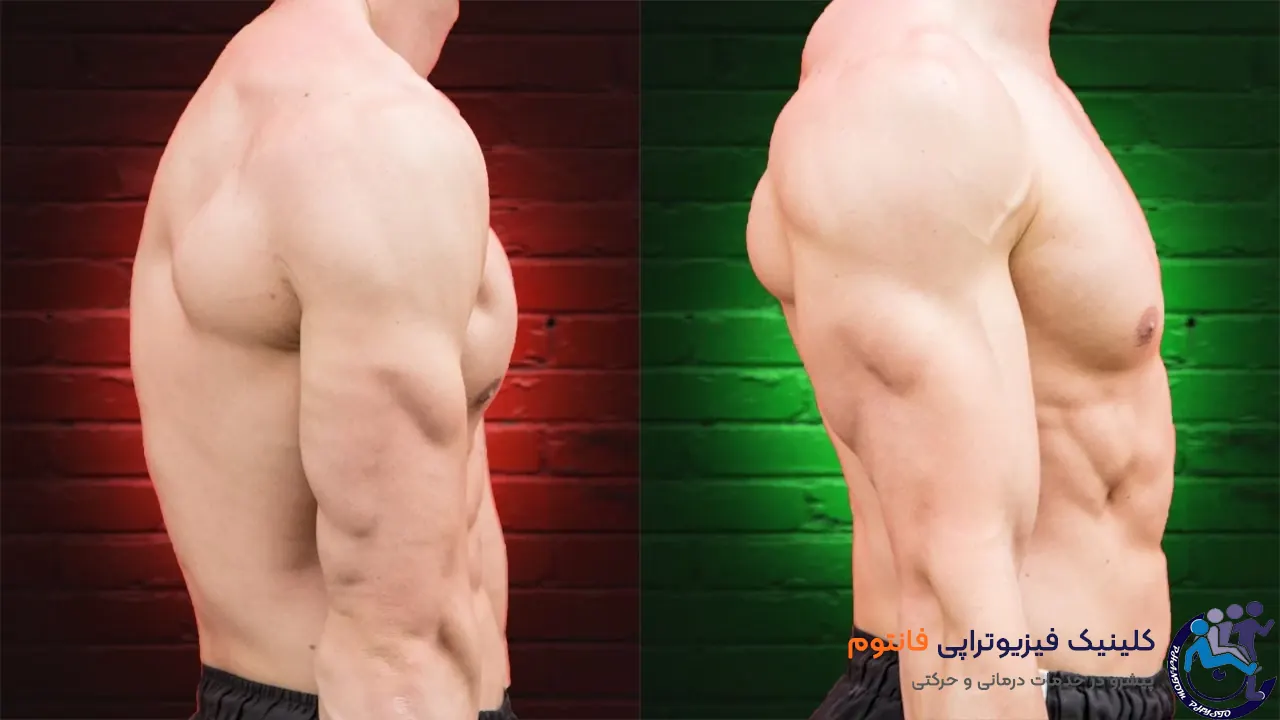 علل ایجاد شانه های گرد و افتاده