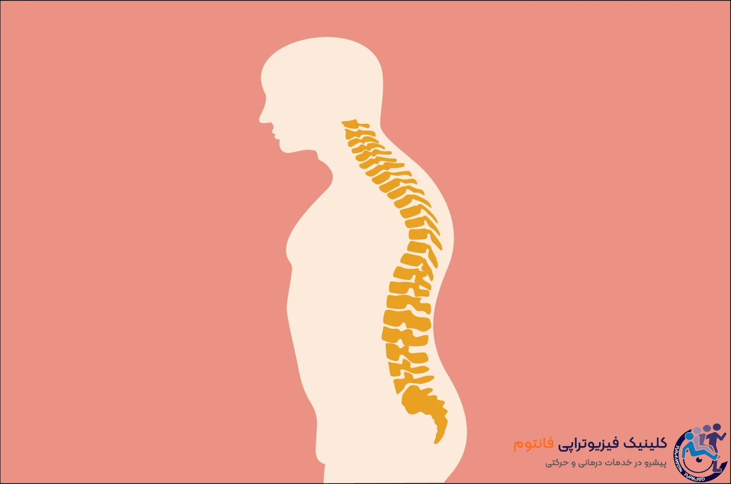 علائم کیفوز چیست؟