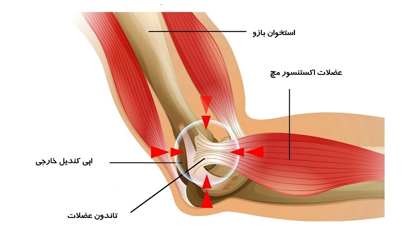 علائم آرنج تنیس بازان