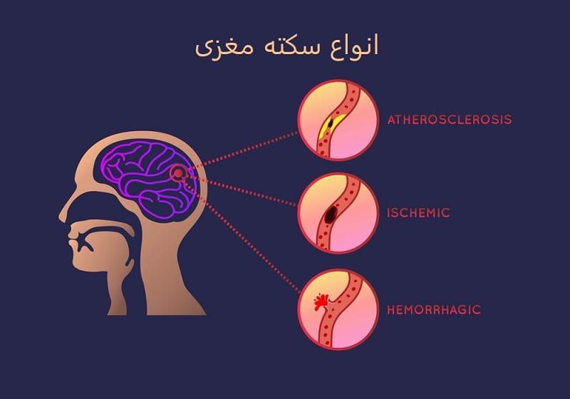 علائم سکته مغزی