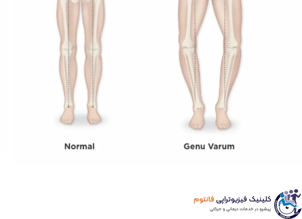 دلیل پرانتزی شدن پای کودکان