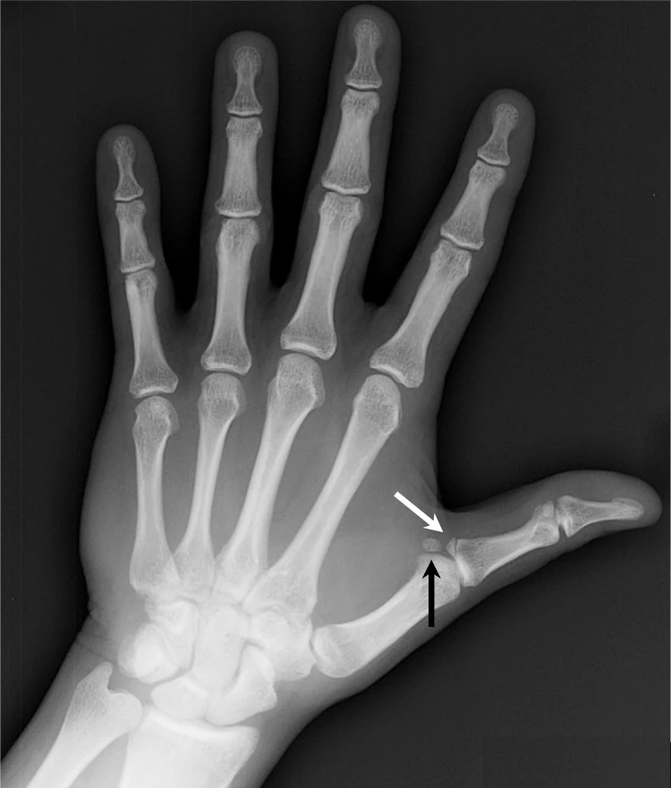 چه عاملی منجر به انگشت شست اسکی بازان می‌شود؟ 