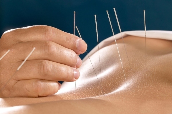 طب سوزنی برای کمر درد فیزیوتراپی فانتوم زنجان