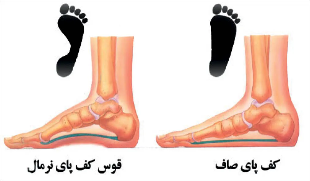 تشخیص صافی کف پا