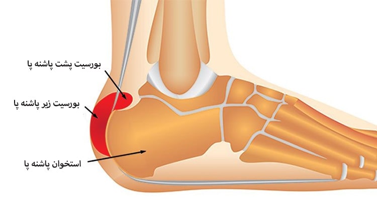 علائم درد پاشنه چیست؟ فیزیوتراپی فانتوم زنجان