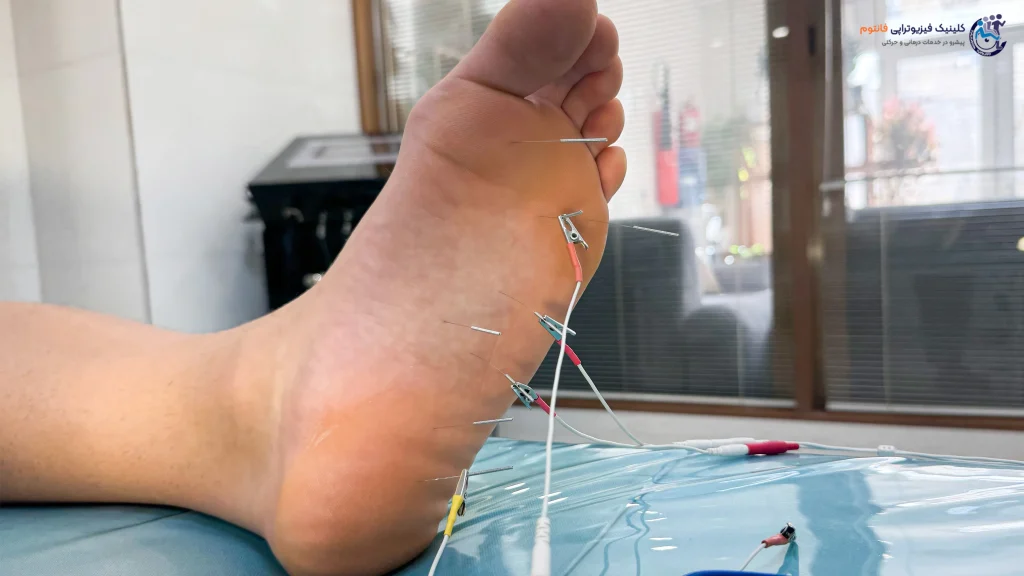 طب سوزنی یا آکوپانکچر کف پاـ تصویر از فیزیوتراپی فانتوم زنجان