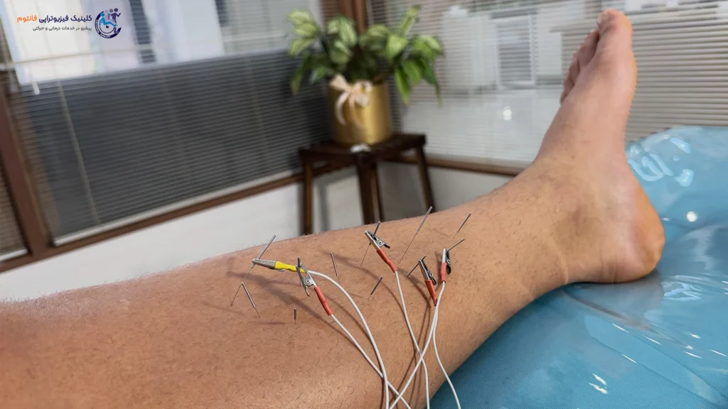 طب سوزنی یا آکوپانکچر ساق پاـ تصویر از فیزیوتراپی فانتوم زنجان