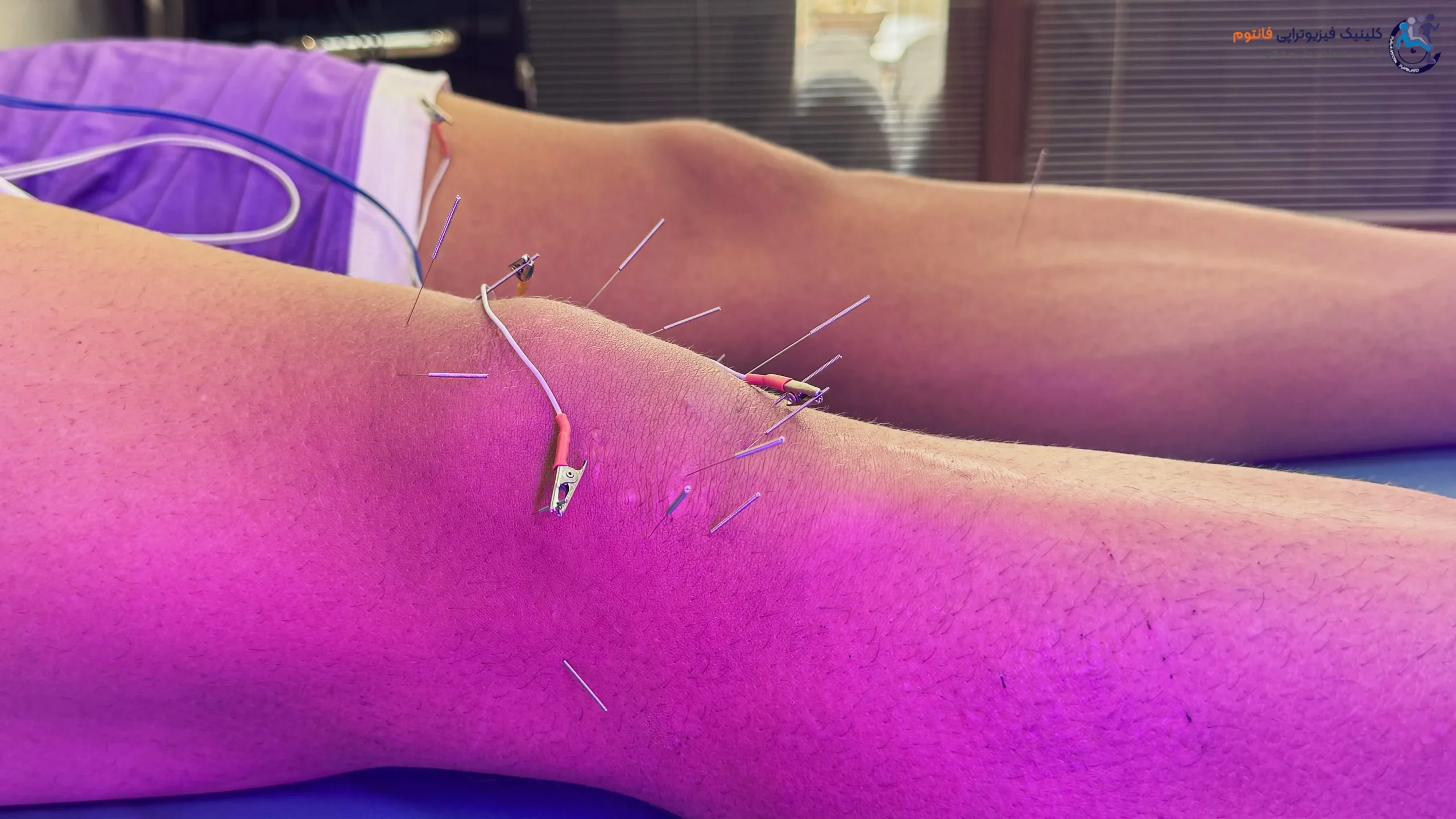 طب سوزنی یا آکوپانکچرـ تصویر از فیزیوتراپی فانتوم زنجان