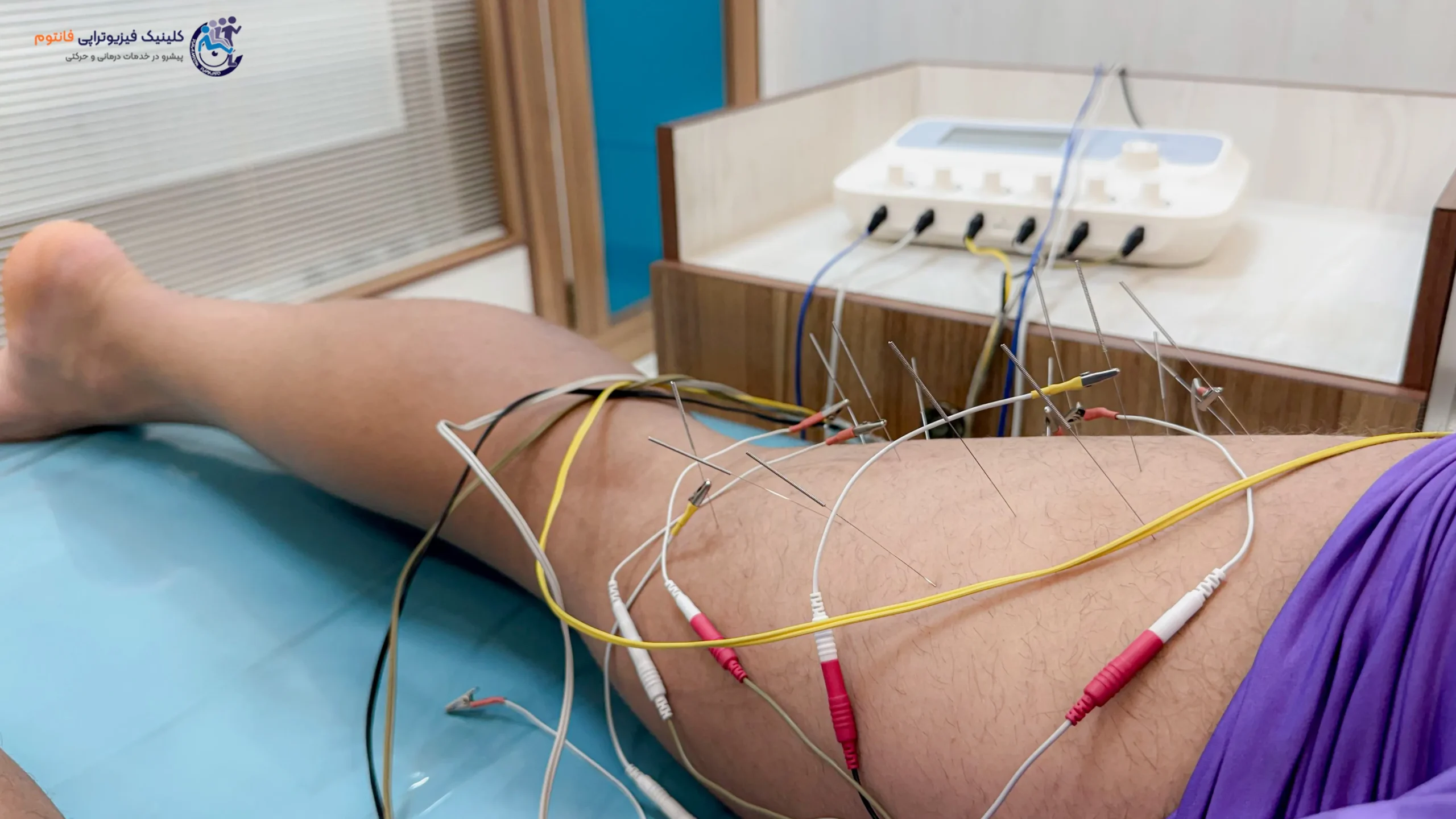 طب سوزنی یا آکوپانکچرـ تصویر از فیزیوتراپی فانتوم زنجان