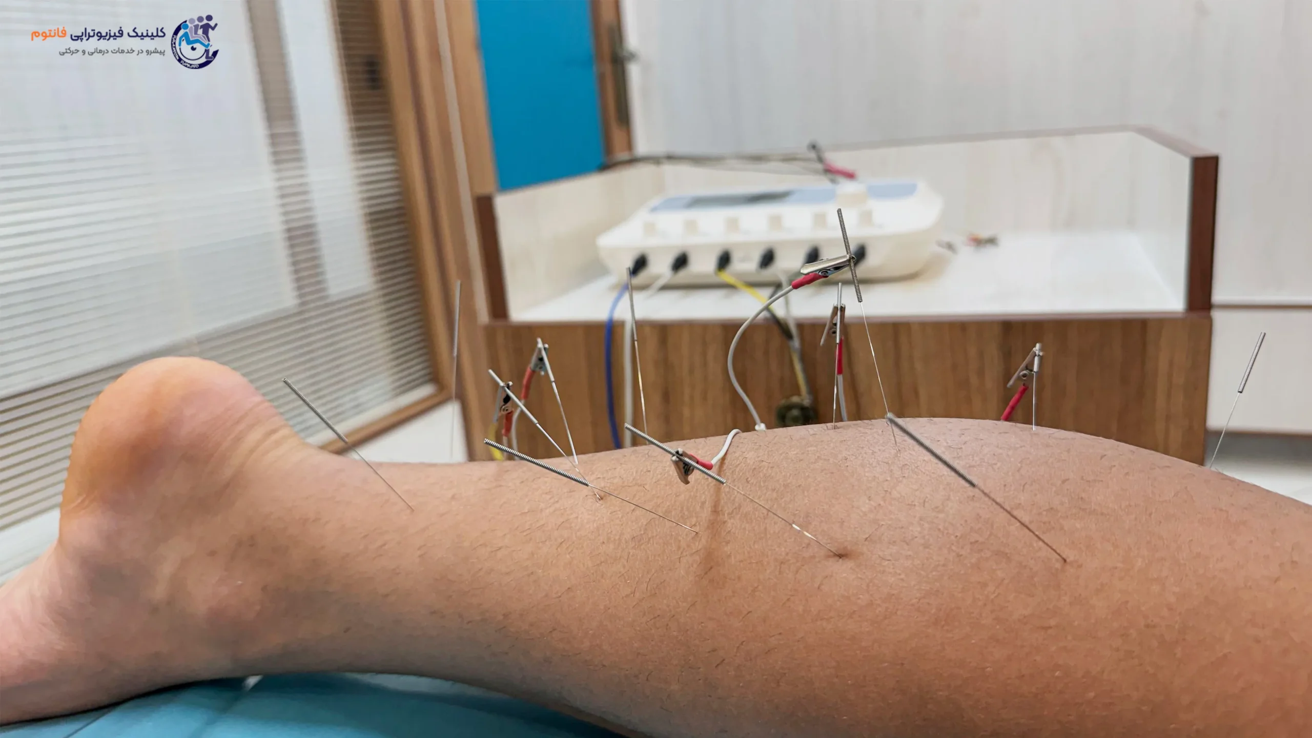 طب سوزنی یا آکوپانکچرـ تصویر از فیزیوتراپی فانتوم زنجان