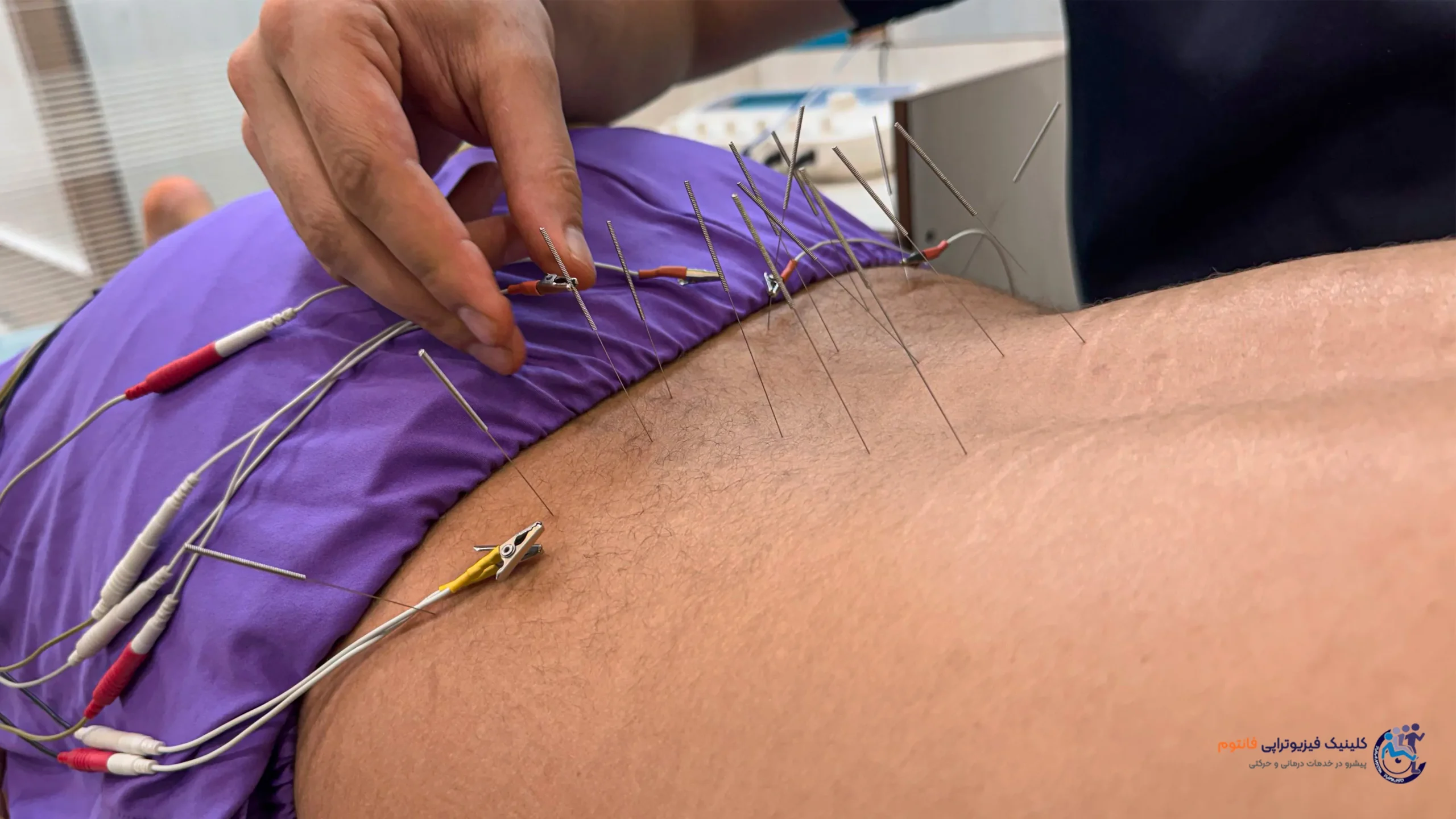 آکوپانکچر یا طب سوزنی کمر ـ تصویر از فیزیوتراپی فانتوم زنجان