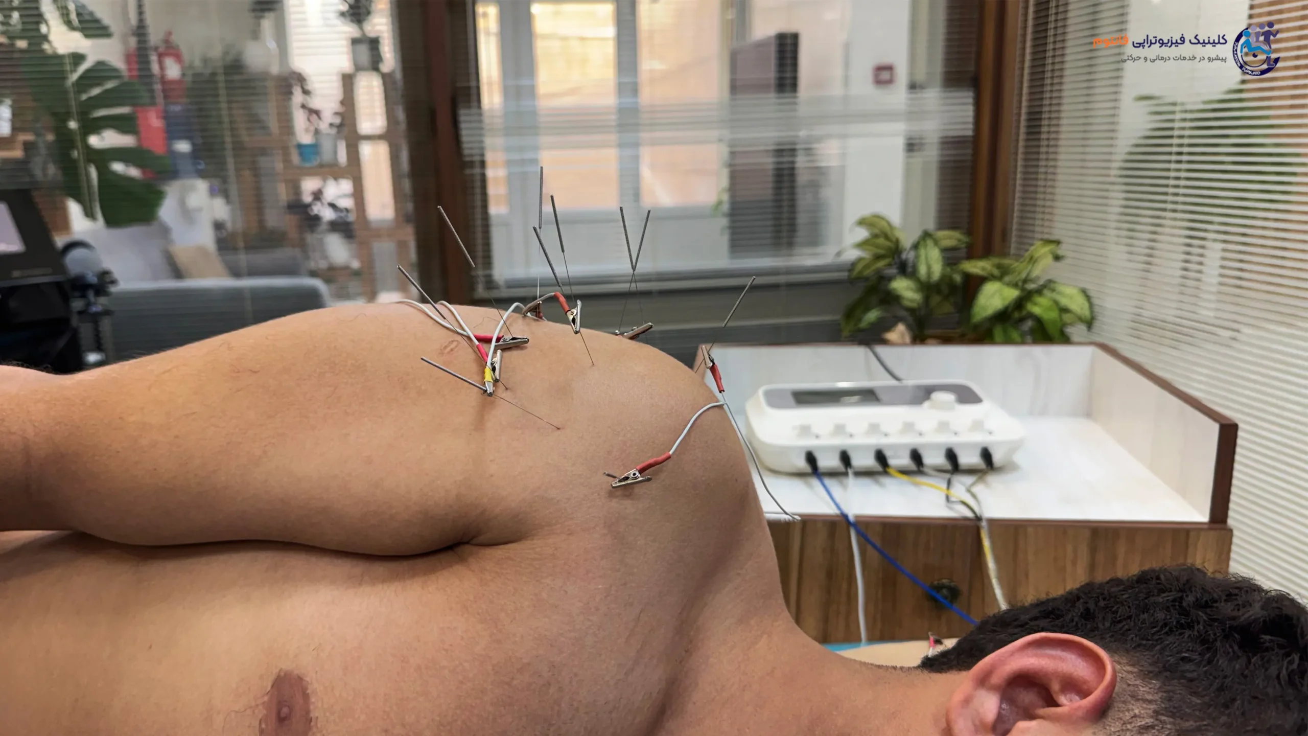 طب سوزنی یا آکوپانکچرـ تصویر از فیزیوتراپی فانتوم زنجان