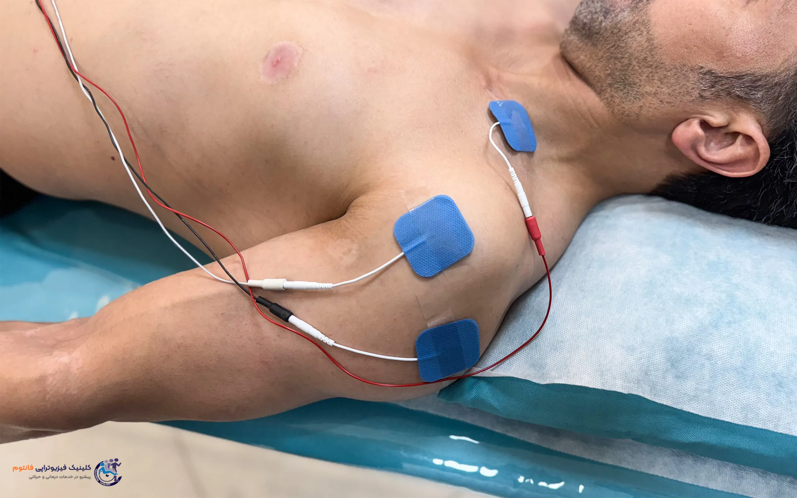 بیوفیدبک شانه- تصویر از فیزیوتراپی فانتوم زنجان