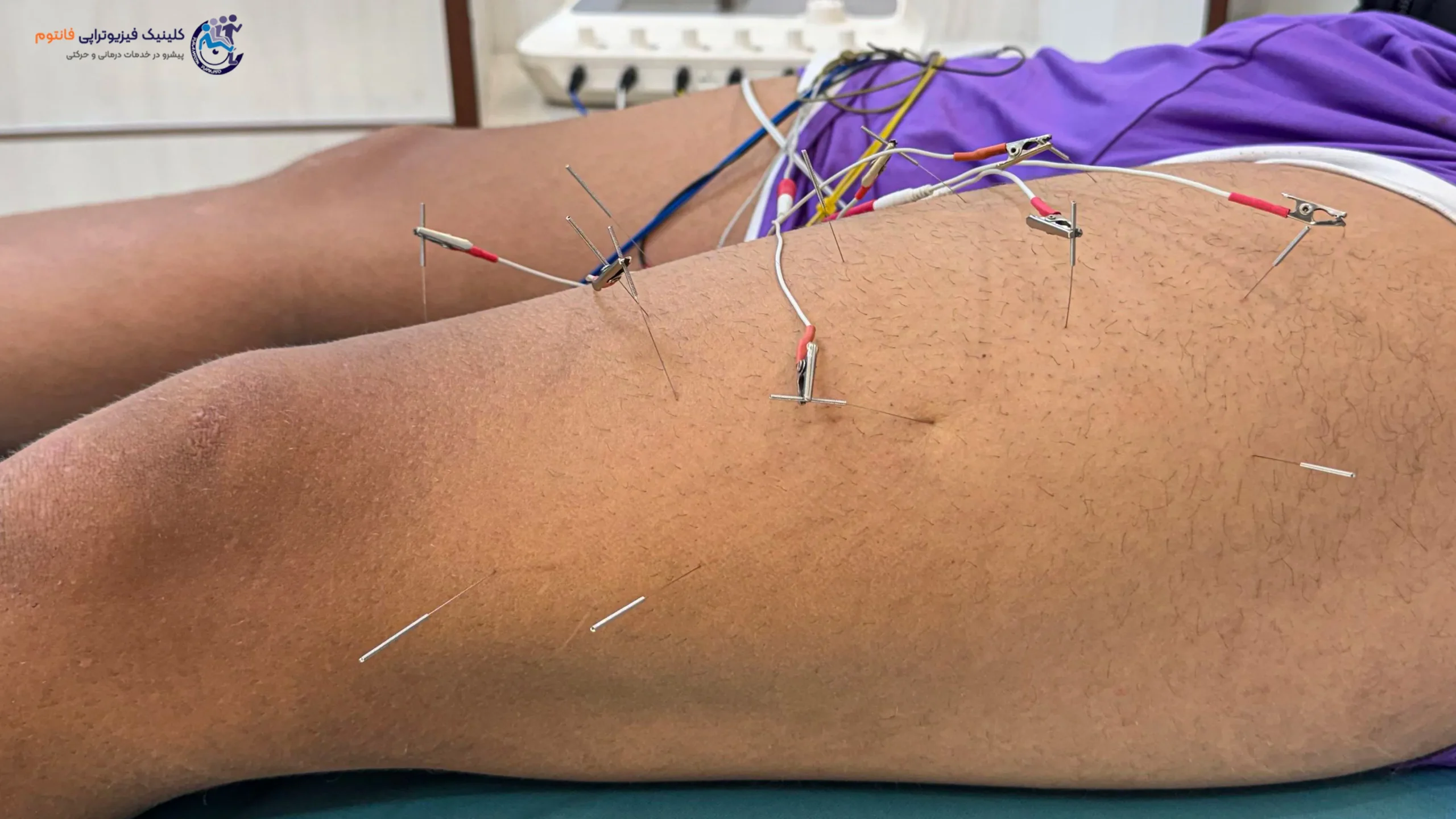 طب سوزنی یا آکوپانکچرـ تصویر از فیزیوتراپی فانتوم زنجان