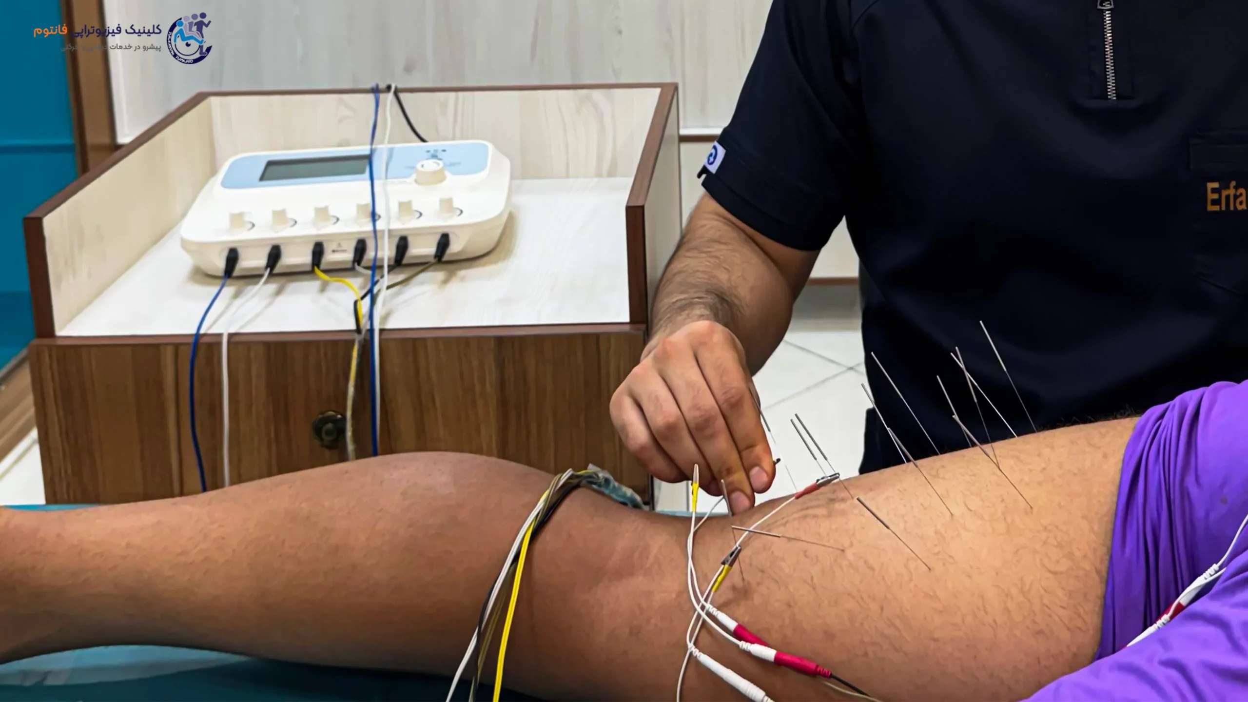 طب سوزنی یا آکوپانکچرـ تصویر از فیزیوتراپی فانتوم زنجان