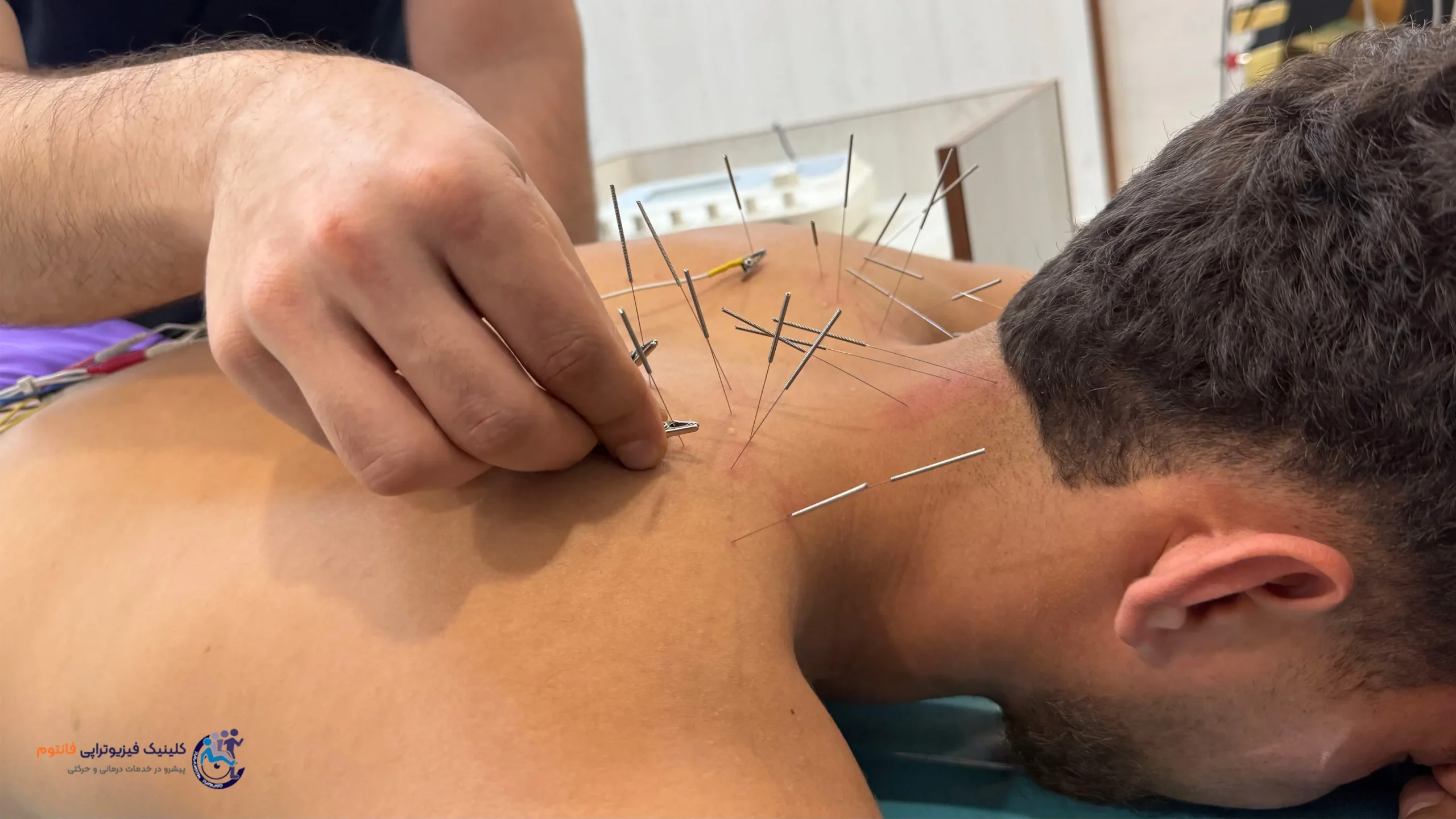 آکوپانکچر یا طب سوزنی گردن ـ تصویر از فیزیوتراپی فانتوم زنجان