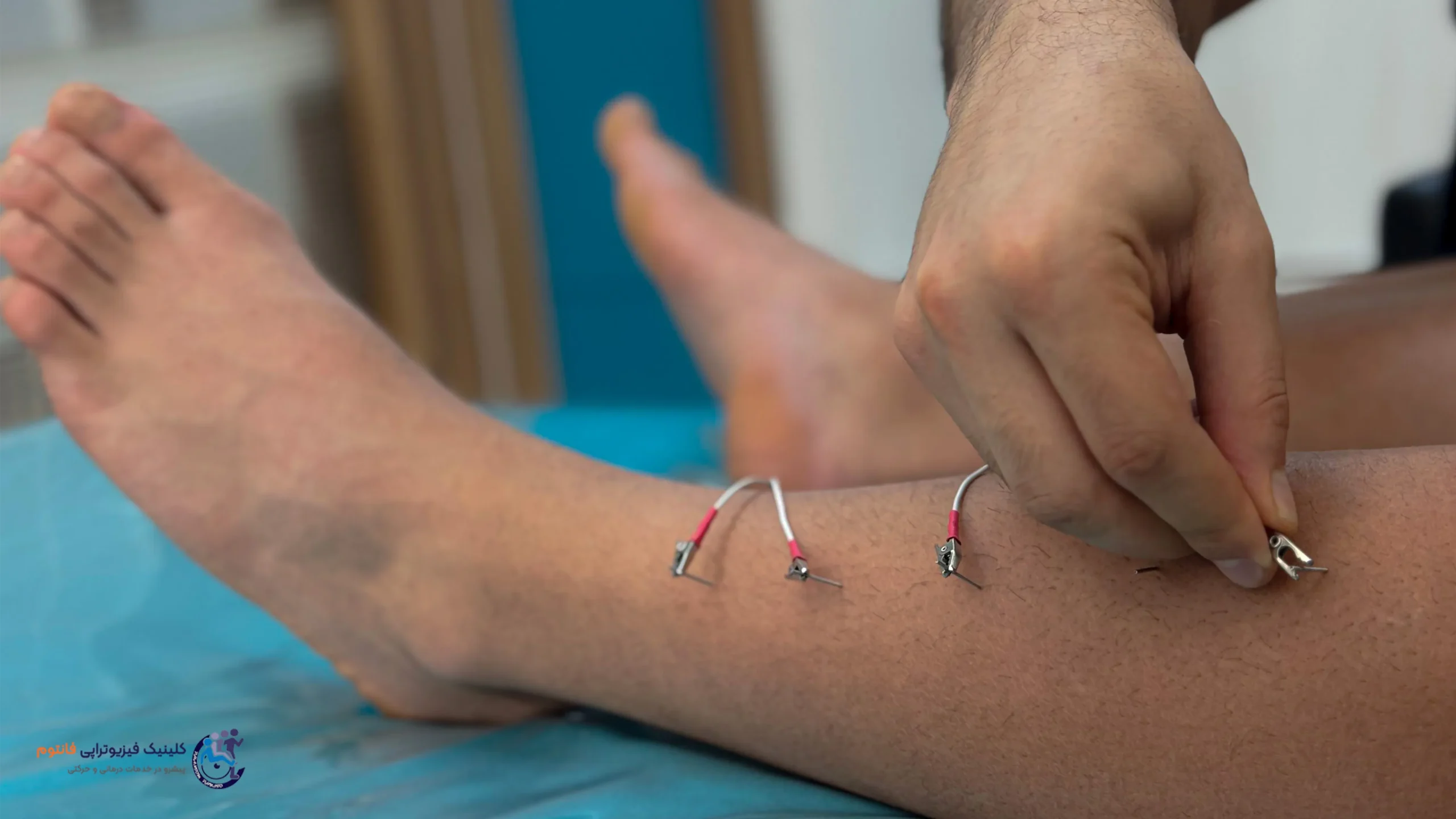 طب سوزنی یا آکوپانکچرـ تصویر از فیزیوتراپی فانتوم زنجان